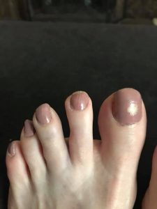 hurt middle toe