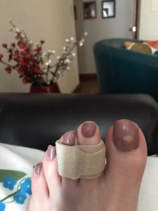 "Buddy-wrapping" my hurt toe & elevating my foot on pillows
